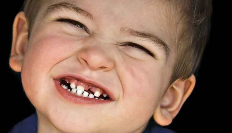 دندان قروچه کودک در خواب چیست و به چه علت ایجاد می شود؟ درمان + پیشگیری
