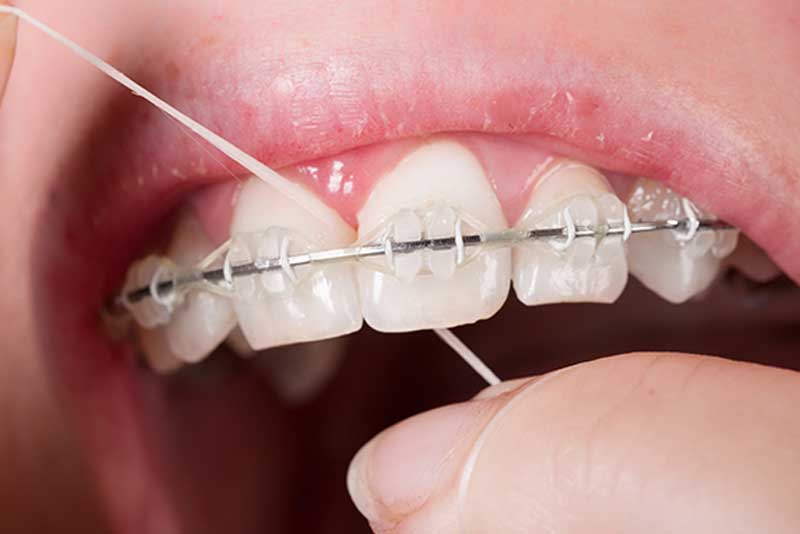 استفاده از نخ دندان با براکت