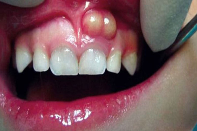  عفونت دندان 