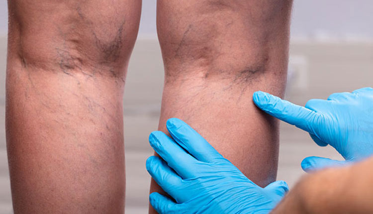 درمان واریس پا