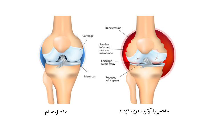 مقایسه مفصل سالم با آرتریت روماتوئید