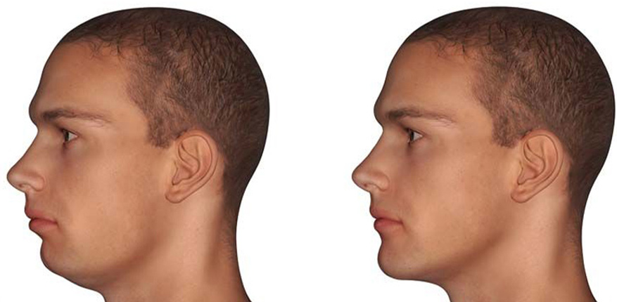 نتایج کربوکسی تراپی غبغب