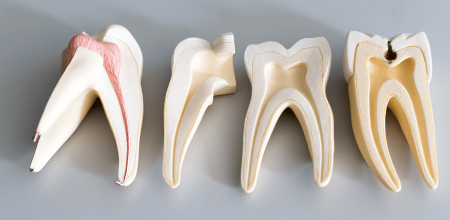 مراحل درمان پالپوتومی
