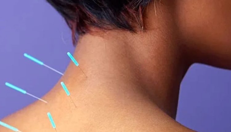 طب سوزنی برای گردن درد