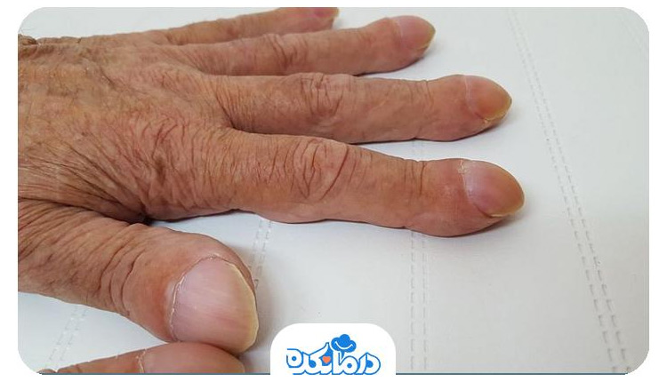 تصویری از فردی که دستانش درگیر بیماری استئوآرتروپاتی هیپرتروفیک شده است و ناخن‌هایی با شیب به سمت پایین دارد.