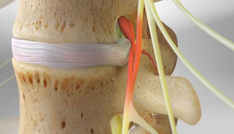 مشکلات دیسک مانند فتق یا دژنراسیون