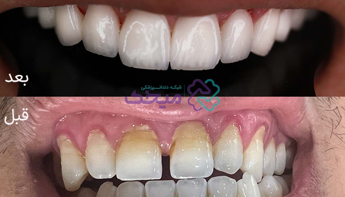 طرح ویژه لمینت اقساطی میخک