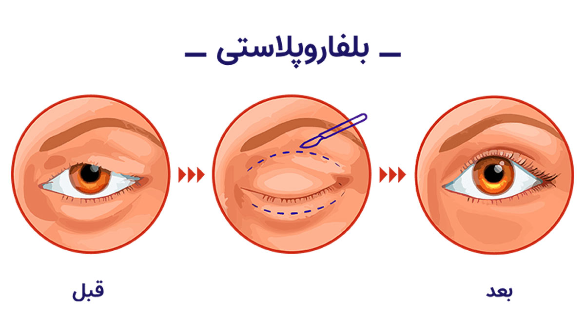 معایب بلفاروپلاستی