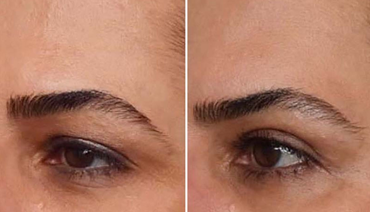 مزایای عمل زیبایی بلفاروپلاستی