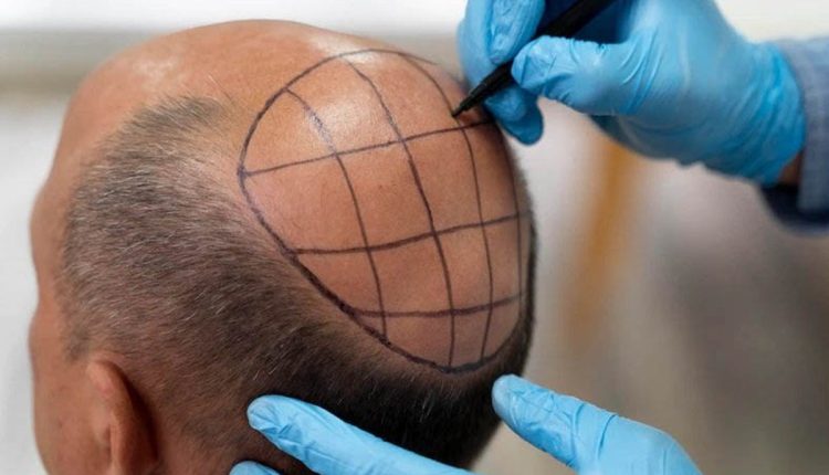 بهترین روش کاشت مو