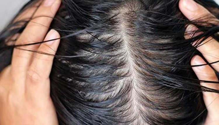 بهترین شامپو برای ریزش موهای چرب