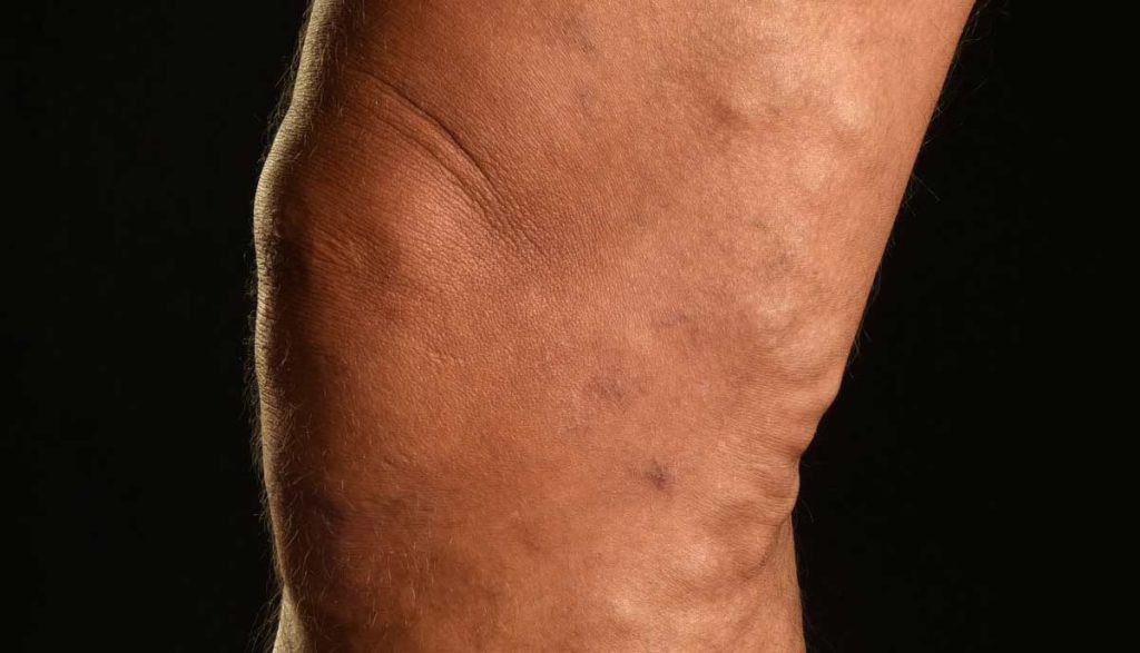 جلوگیری از تشدید واریس