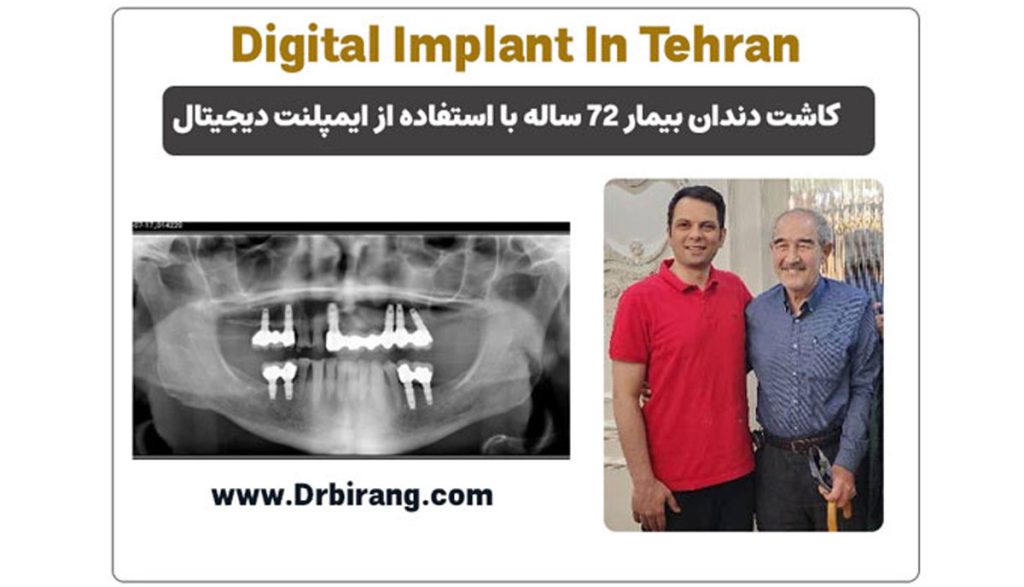 ایمپلنت دندان برای افراد دیابتی؛ پایان یک حسرت قدیمی با تکنولوژی دیجیتال